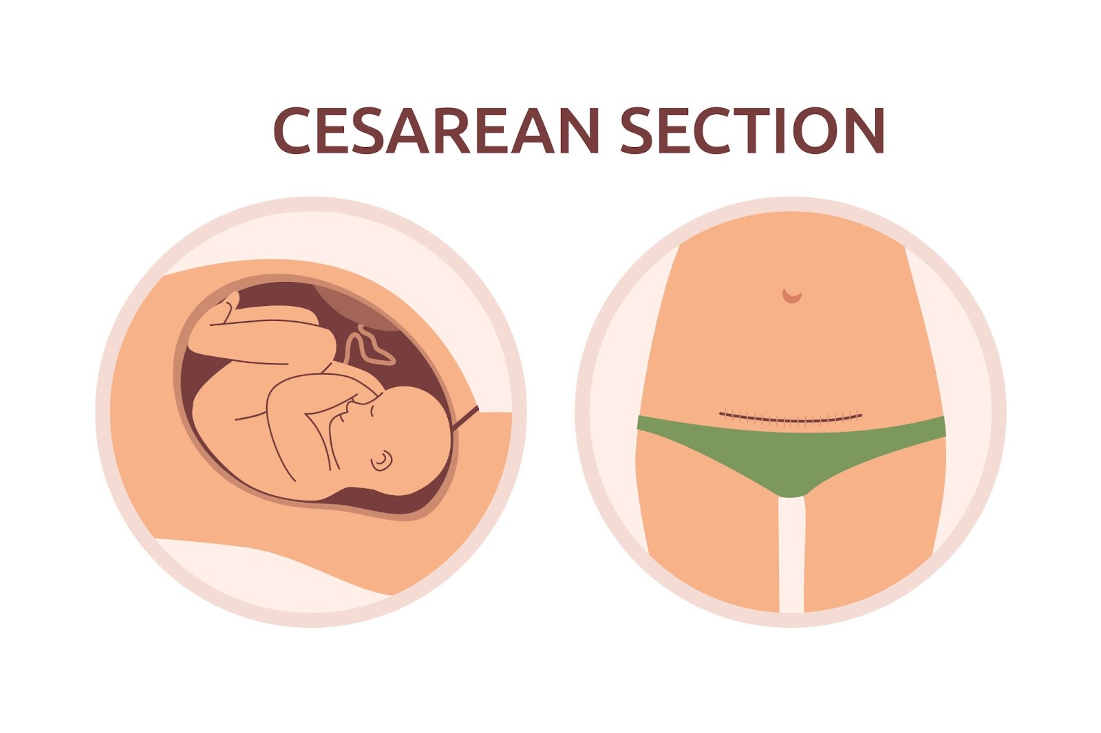 operasi caesar